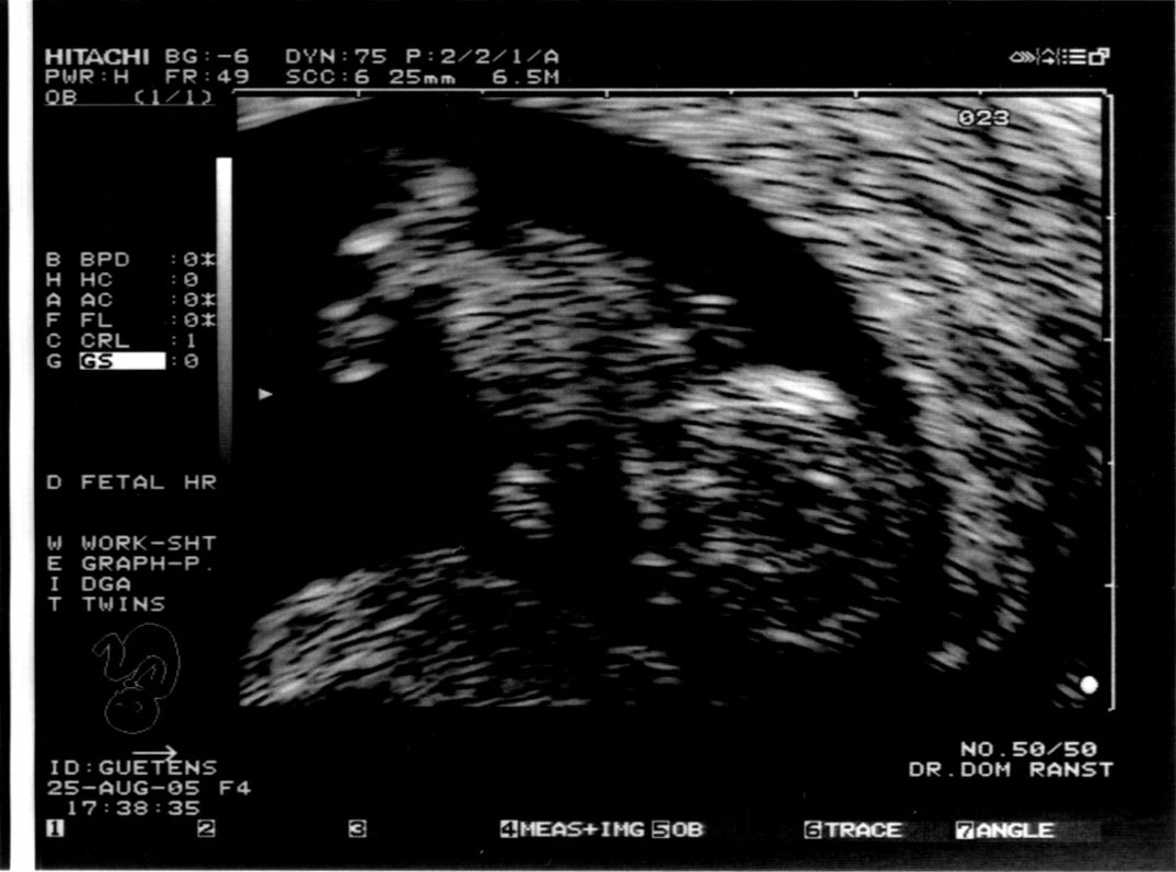 Ultrasound image