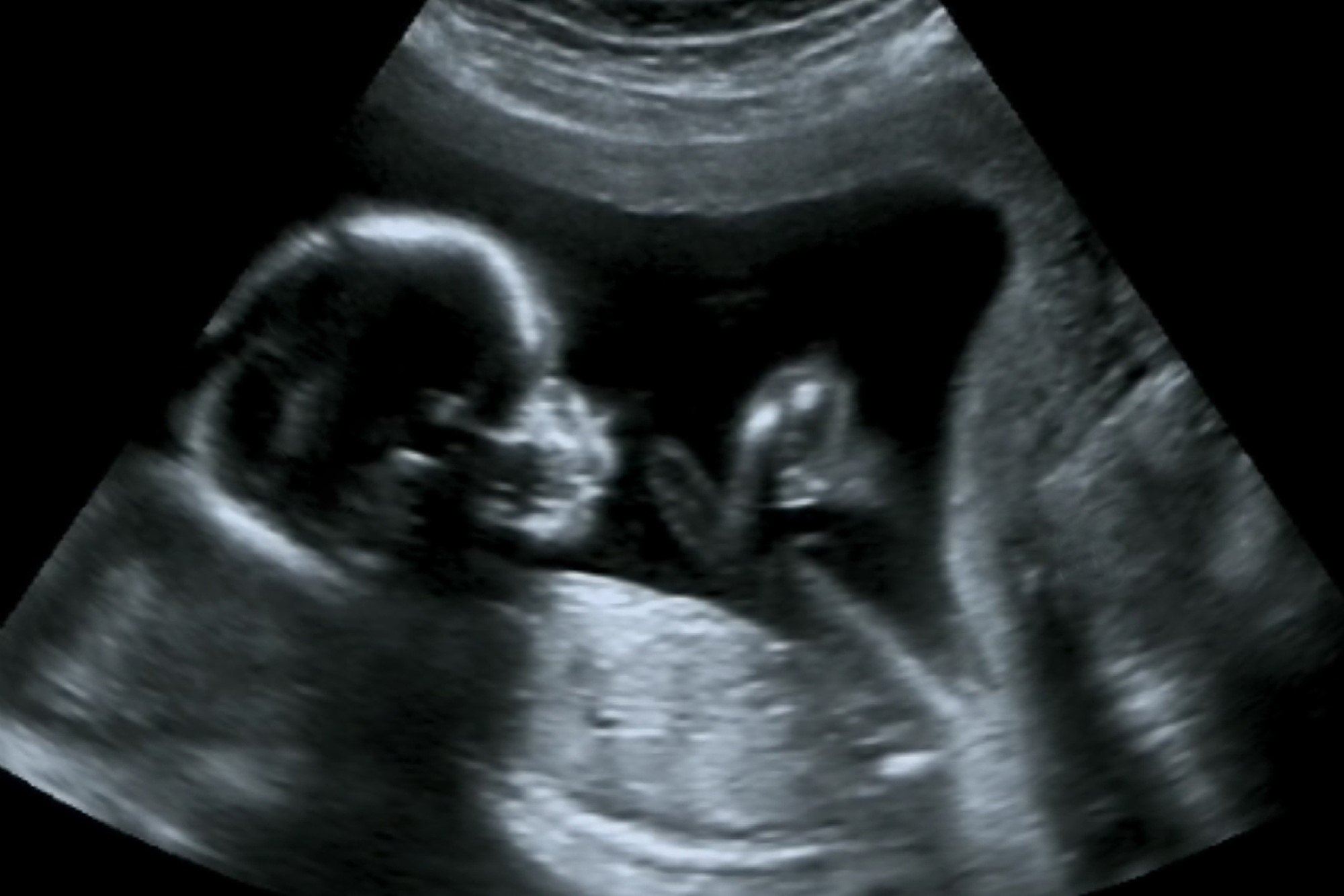 ultrasound image